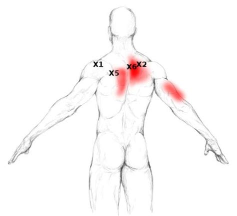 Image result for Trapezius Referred Pain Pattern