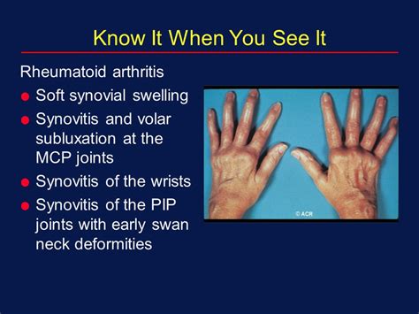 Image result for What Does Synovitis Look Like