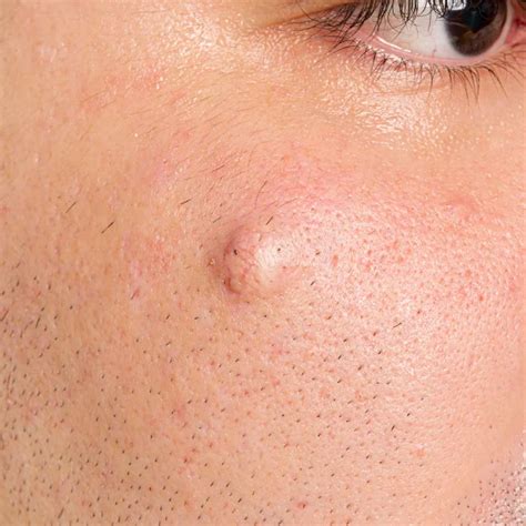 Image result for Sebaceous Cyst Pimple