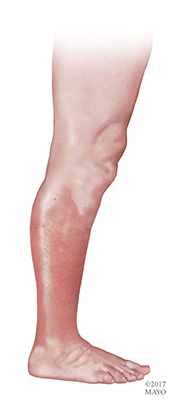 Image result for Cellulitis On Torso