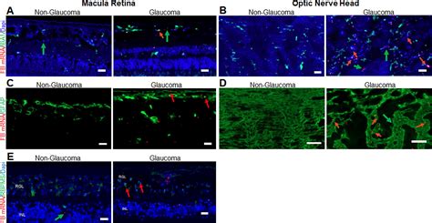 Complement Factor B Gene に対する画像結果