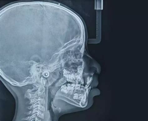 Image result for Maxillary Protraction