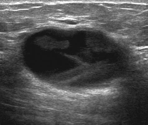 Simple Cyst On Ultrasound に対する画像結果