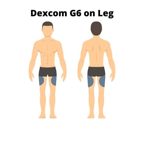 Toradh íomhá ar Dexcom G6 Sensor Placement