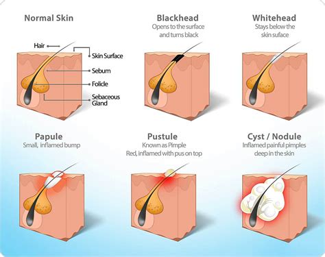 Inside Nodule Acne に対する画像結果