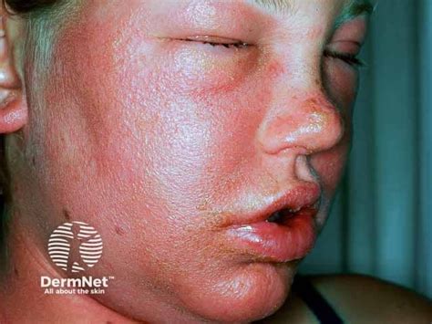 Rhus Dermatitis Face-এর ছবি ফলাফল