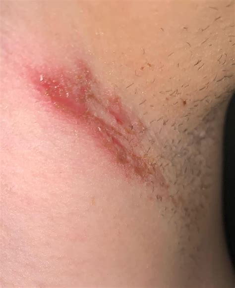 Image result for Painful Pimple Under Armpit