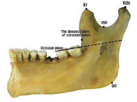 Mandibular Foramen に対する画像結果