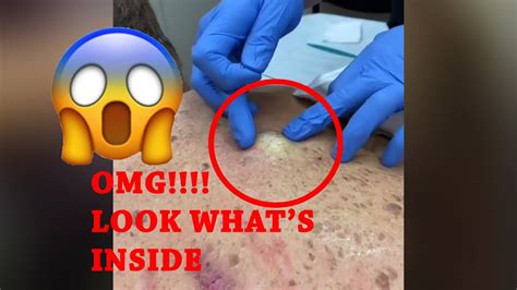 Image result for Exploding Cyst Sac