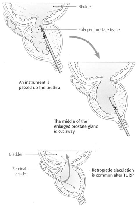 Bladder Neck Resection に対する画像結果