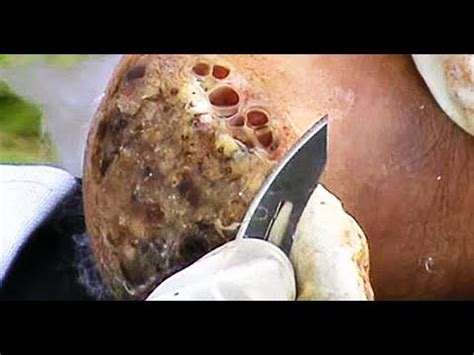 Image result for Mango Worms in Humans