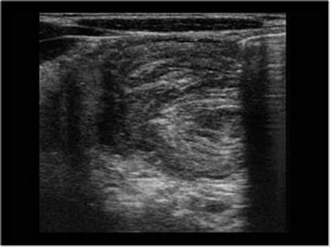 Image result for Intussception in Ultrasound