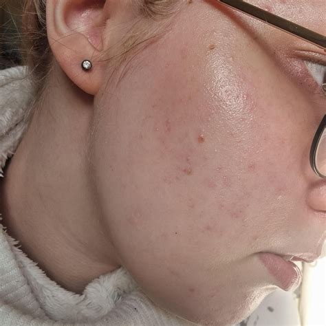 Image result for How to Fix Cheeck Spots