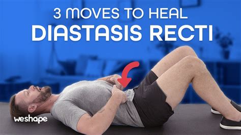 Toradh íomhá ar Diastasis Recti in Men Exercises