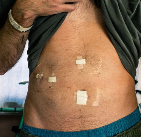 Image result for Gallbladder Removal