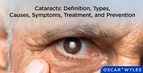 Toradh íomhá ar Cataract Symptoms