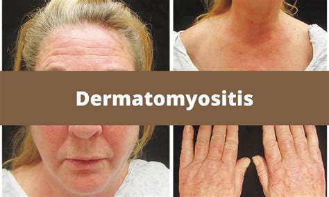 Image result for Dermatomyositis Rash On Chest