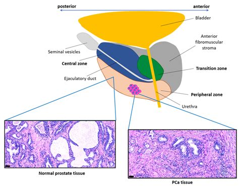 Prostate Cancer Vector Icon に対する画像結果