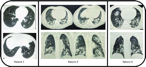 Image result for High Resolution CT Scan