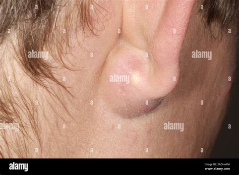 Toradh íomhá ar Exploding Cysts Newest