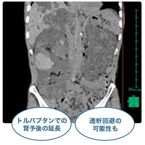 Image result for CKD Robert