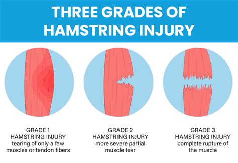 Résultat d’images pour Level 2 Hamstring Tear