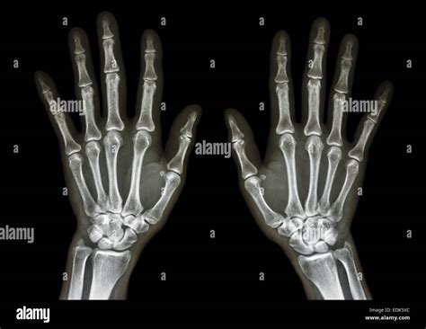 Image result for Normal Hand