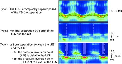 Toradh íomhá ar Conventional Manometry vs High Resolution Manometry
