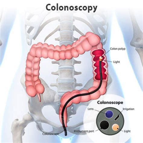 Image result for Colonoscopy Cecum