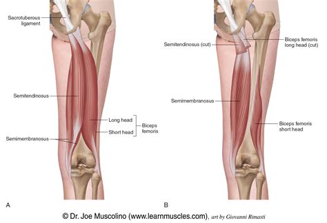 Calcifications Hamstring に対する画像結果