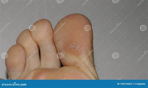 Toradh íomhá ar Wart Toe