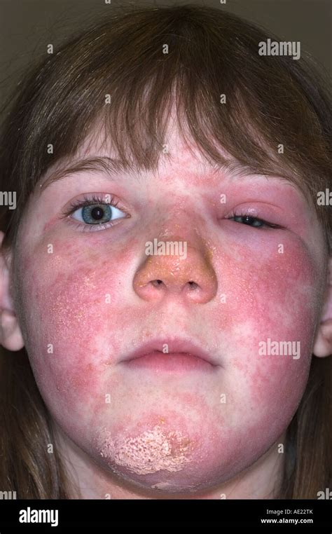 Rhus Dermatitis Face-এর ছবি ফলাফল