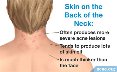 Neck Acne - Acne.org