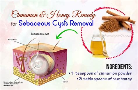DIY Remove Sebaceous Cyst に対する画像結果