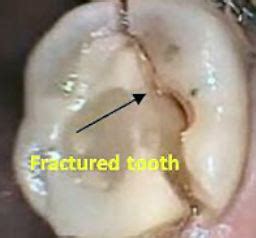 Image result for Broken Tooth Bleeding