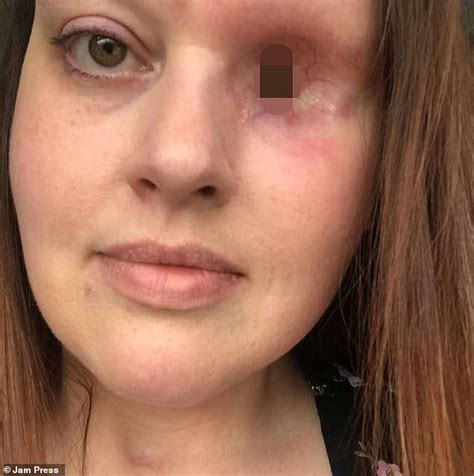 Image result for Eye Pops Out of Socket