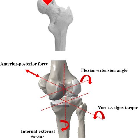 Image result for PF Joint-Replacement
