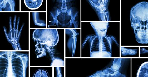 Image result for X Ray Radiation