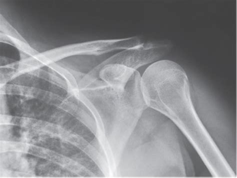 Image result for What Is Shoulder Internal Rotation