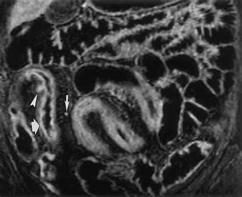 Image result for MRI Enteroclysis