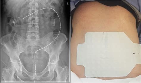 Image result for High Resolution Colonic Manometry Drawing