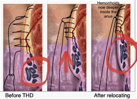 THD Procedure に対する画像結果