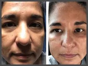 Image result for What Is a Vampire Facelift