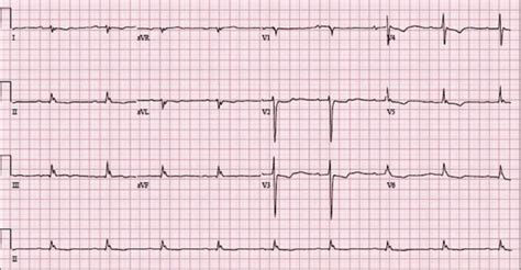 Image result for Digoxin Pulse Waveform