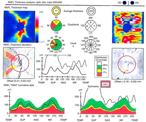 Image result for Optical Coherence Tomography Explained