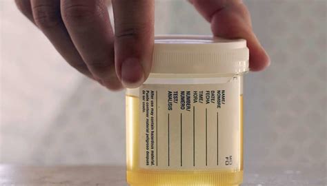 Image result for Dysmorphic RBC in Urine