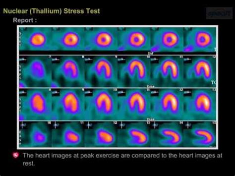 Image result for Siemens Orbiter Nuclear Stress Test