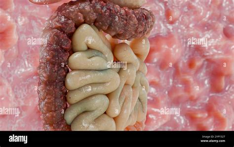 Colon Cancer Images Colonoscopy に対する画像結果