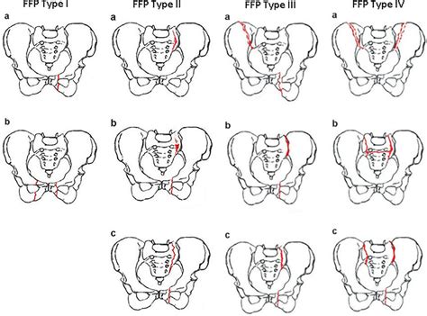 Afbeeldingsresultaten voor Pelvic Fracture Types