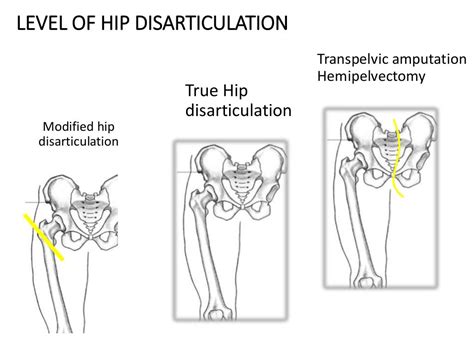 Image result for Disarticulation of Ossicles